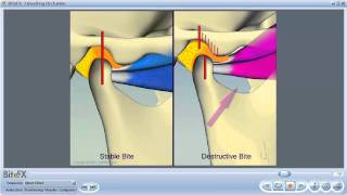 TMJ Disorders [upl. by Sihonn]