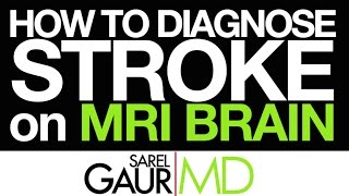 How to Diagnose Stroke on MRI Brain [upl. by Eecyac]