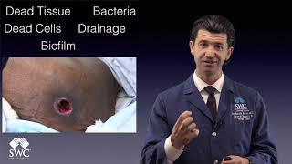 Debridement Myths for Youtube Video [upl. by Franci]