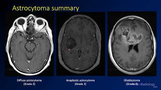 Radiation Treatment for Brain Tumor full procedure [upl. by Dari11]