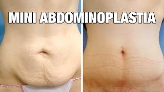 Mini Abdominoplastia antes y después  Testimonio Cristina [upl. by Rondon]