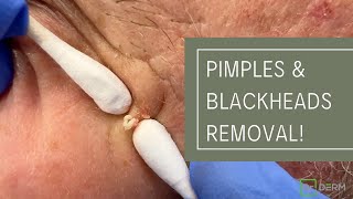 Pimples and Blackheads Removal  Dr Derm [upl. by Lauber]