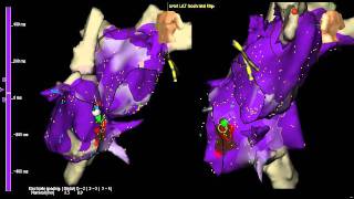 AV Nodal Reentry Tachycardia AVNRT for noncardiologist in less than 2 minutes [upl. by Leidba]