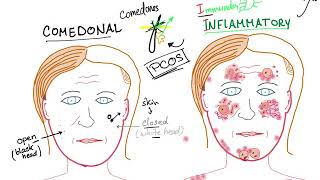 Acne Vulgaris causes subtypes and ttt [upl. by Semela462]