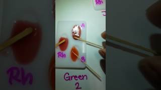 ABO Blood Typing Lab Demonstration [upl. by Aidam]