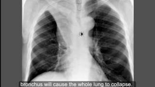 Respiratory System  Chest Conditions Atelectasis  Part 1 [upl. by Browne]