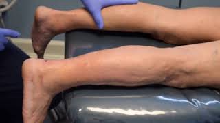 Minimally Invasive Foot Surgery  Achiles Tendon Lengthening [upl. by Ydderf]