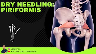 Dry Needling Piriformis [upl. by Neda846]