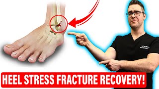 Calcaneus Stress Fracture Treatment Heel Stress Fracture RECOVERY [upl. by Nairrot]