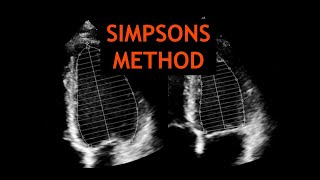 Simpsons Method Echocardiography [upl. by Halona952]