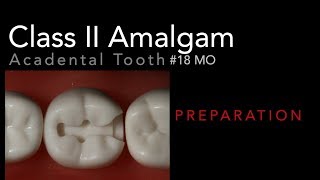 Class II Amalgam Preparation  18 MO Acadental Typodont [upl. by Marc]