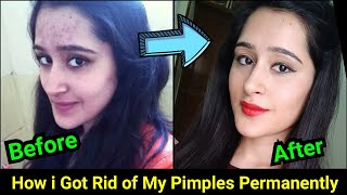 How to Remove Pimples Acne Pimple Marks completely  ThatGlamGirl [upl. by Amelie887]