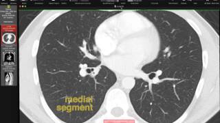 Lobar and Segmental Lung Anatomy on CT [upl. by Upton]