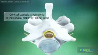 Cervical Stenosis Definition [upl. by Acalia]