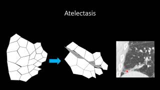 Atelectasis [upl. by Amled]