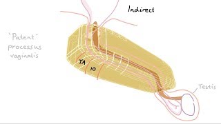 Introduction to Direct and Indirect Inguinal Hernia [upl. by Cassilda]