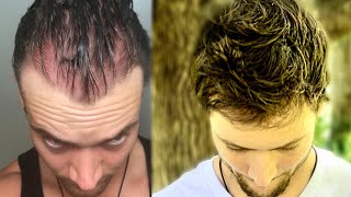 How I Quit The World’s Best Hair Loss Treatment and Regrew My Hair Naturally  Connor Murphy [upl. by Sally752]