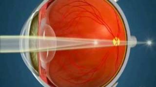 How Orthokeratology Works [upl. by Anej715]