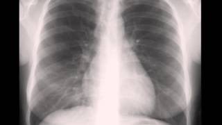 Right Middle Lobe Atelectasis [upl. by Altman]