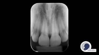 Radiografia Periapical  Radiodoc [upl. by Allmon]