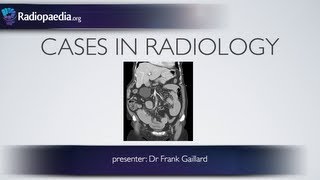 Cases in Radiology Episode 2 abdomen CT [upl. by Acisseg]