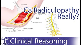 CERVICAL STENOSIS RADICULOPATHY PART 1  SYMPTOMS IMAGING AND PATIENT EXAM [upl. by Scever911]