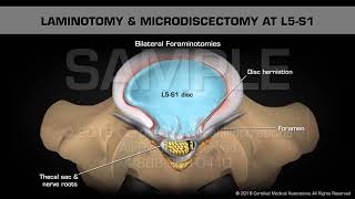 Laminotomy amp Microdiscectomy at L5S1 [upl. by Elyod]