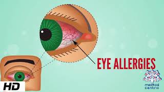 The 3 Causes Of Eye Twitching Tetany – DrBerg [upl. by Meta]