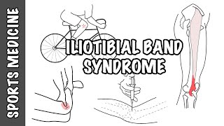 Iliotibial Band Syndrome ITBS  Overview [upl. by Oliy992]