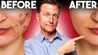 The FASTEST Way to Rid Acne  Dr Berg [upl. by Gnohp]