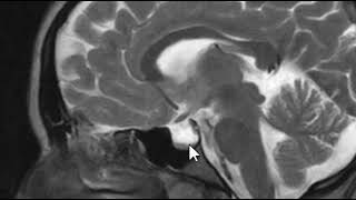 Pseudotumor Cerebri  Brain Scan MRI [upl. by Ettezil823]