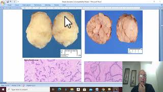 Breast Disorders in Arabic 16  Fibroadenoma  by Dr Wahdan [upl. by Peti906]