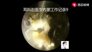 Cleaning cholesteatoma of external auditory canal and tympanic enucleation with otoendoscopy [upl. by Neerod965]