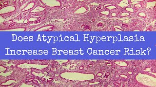 Does Atypical Hyperplasia Increase Breast Cancer Risk [upl. by Onig]