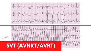 Advanced EKGs  WolffParkinsonWhite WPW Syndrome [upl. by Quill]