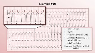 AV Nodal Reentry Tachycardia AVNRT on ECG  EKG [upl. by Sedecram804]