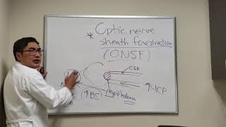 Optic Nerve Sheath Fenestration [upl. by Lucania]