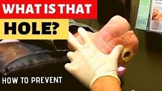 HOW WE TREAT DIABETIC WOUNDS [upl. by Particia834]