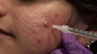 Watch amp Learn Intralesional injections [upl. by Limemann]