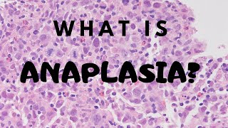 What is Anaplasia  Pathology mini tutorial [upl. by Alvin685]