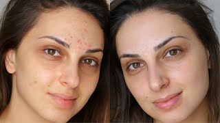 BENZOYL PEROXIDE BEST WAY TO GET RID OF SPOTS [upl. by Queena]