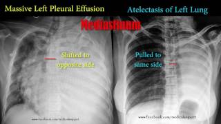 pleural effusion vs atelectasis [upl. by Anilek]