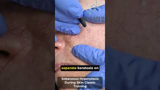 Sebaceous Hyperplasia Skin Classic [upl. by Sharia]