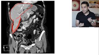 Riedels lobe of the liver  Accessory liver lobe [upl. by Lectra]