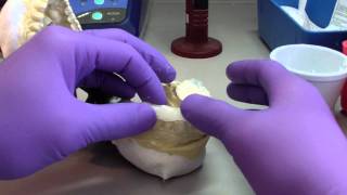 Bruxism Splint  Part 4  Developing the Occlusal Surface [upl. by Llecrep]