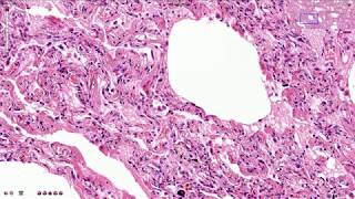 ARDS  Acute Respiratory Distress Syndrome  Histopathology [upl. by Nidia]