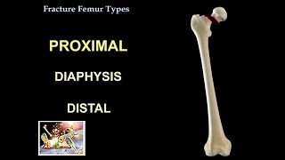 After how long can one play sports post Femur Fracture Surgery  Dr Mohan M R [upl. by Derraj586]