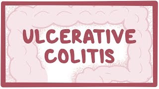 Living with Ulcerative Colitis Patient Stories [upl. by Samella]