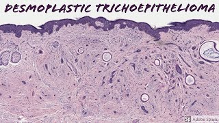 Desmoplastic Trichoepithelioma 5Minute Pathology Pearls [upl. by Cynthie]