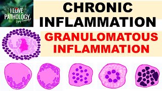 INFLAMMATION Part 9 Chronic Inflammation  GRANULOMATOUS INFLAMMATION [upl. by Irwinn]